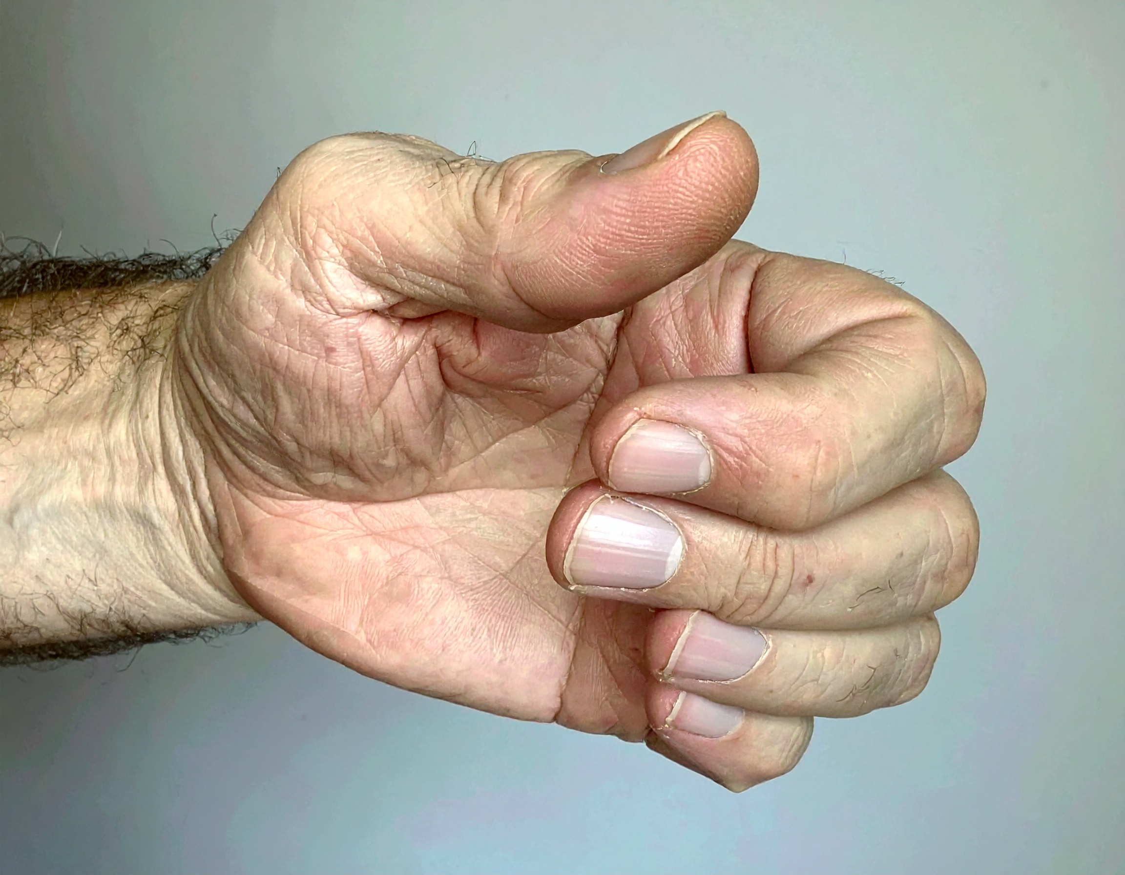 Firefly_gros plan sur une main d’un homme blanc de 45 ans avec le pouce tordu par l’arthrose 557190 Main faisant un geste de pouce levé.