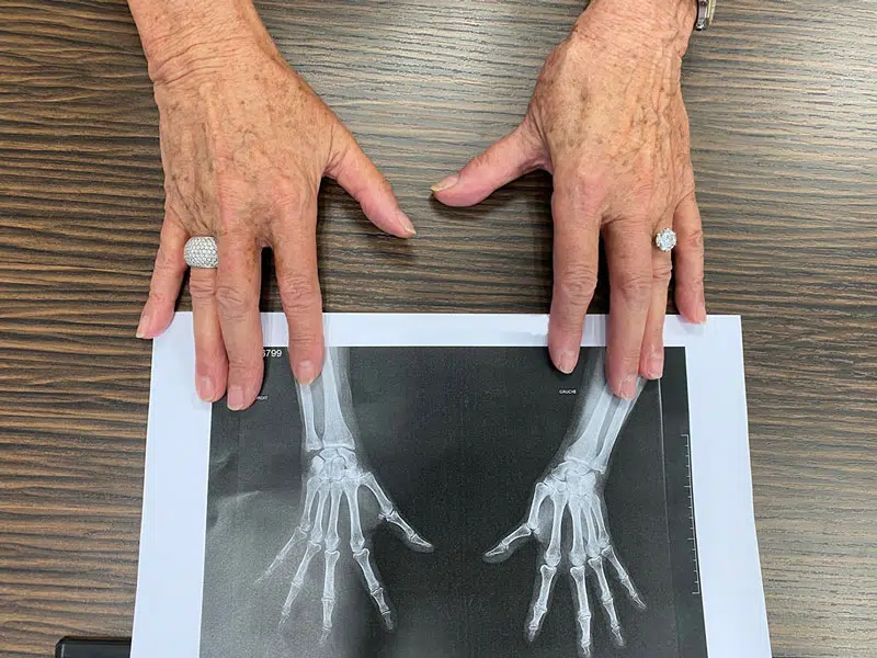 rhizarthrose-traiter-pouce-en-z.jpg Mains tenant une radiographie des os des mains