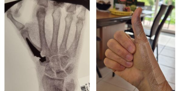Radiographie et main avec bandage.