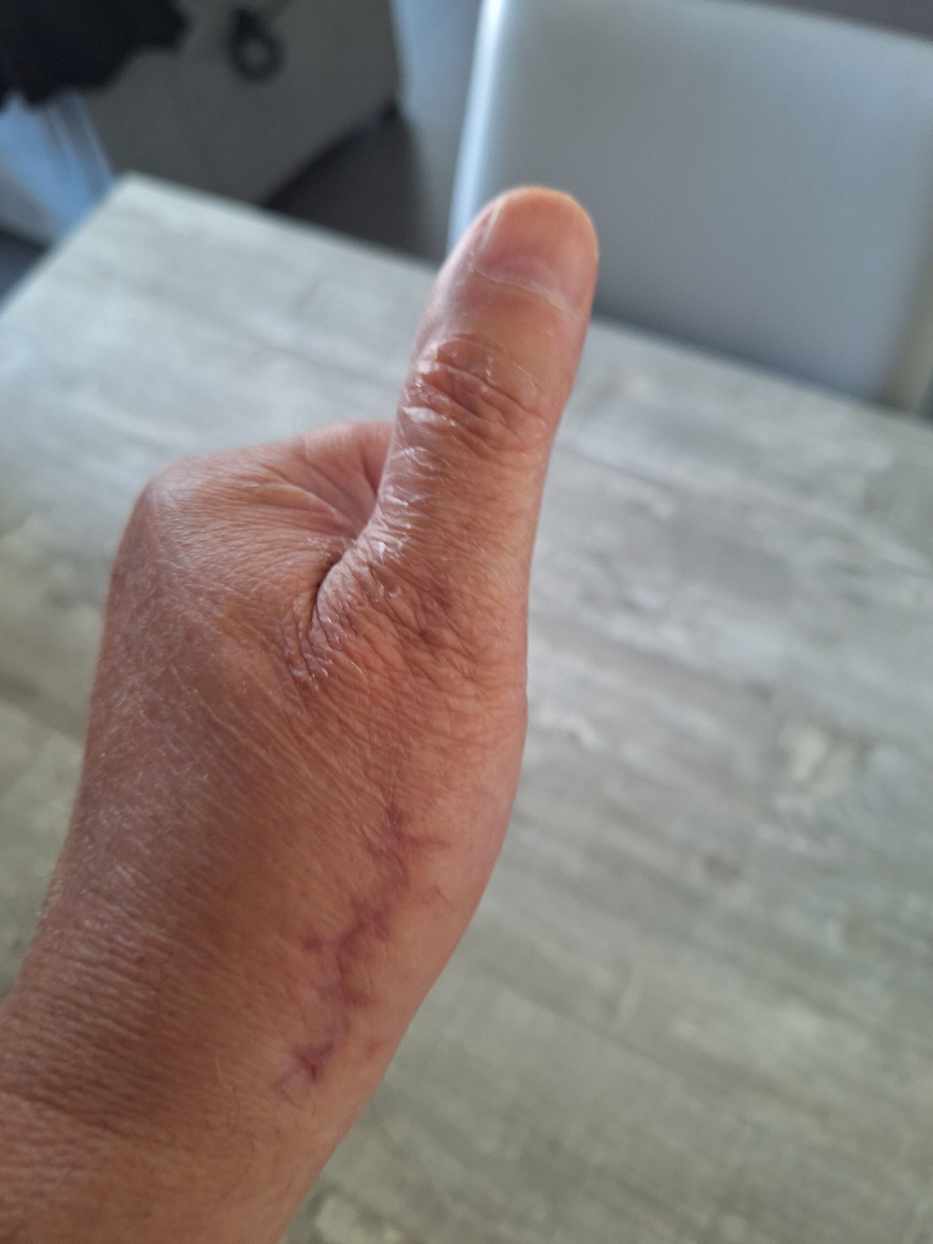 Main avec cicatrice sur le pouce